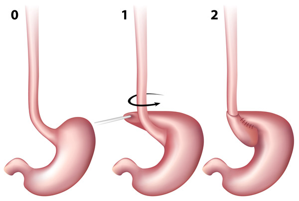Ablauf einer Fundoplicatio
